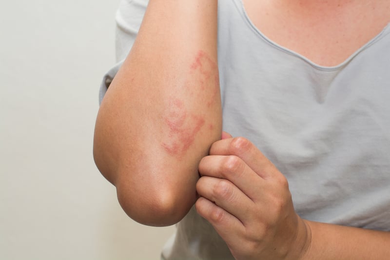 Some people who have tested positive for Omicron have reported getting three different types of skin rashes. These include hives, prickly heat and chilblains, all of which can cause the skin to become red and itchy. Applying calamine lotion to the affected area, or taking an antihistamine tablet can help.