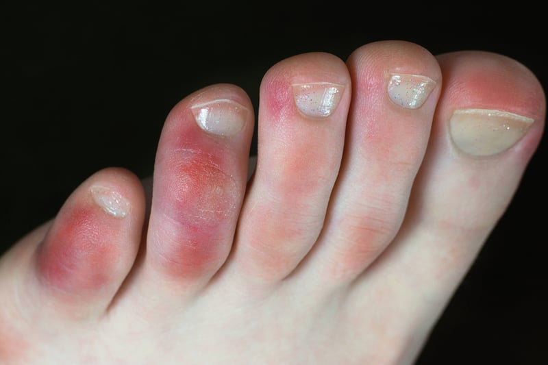 Covid can cause fingers and toes to become swollen and change colour, with symptoms including chilblain-like inflammation, redness, blisters and itching on the hands and feet. It appears to be more common among children and young adults, and can last for months in some cases.