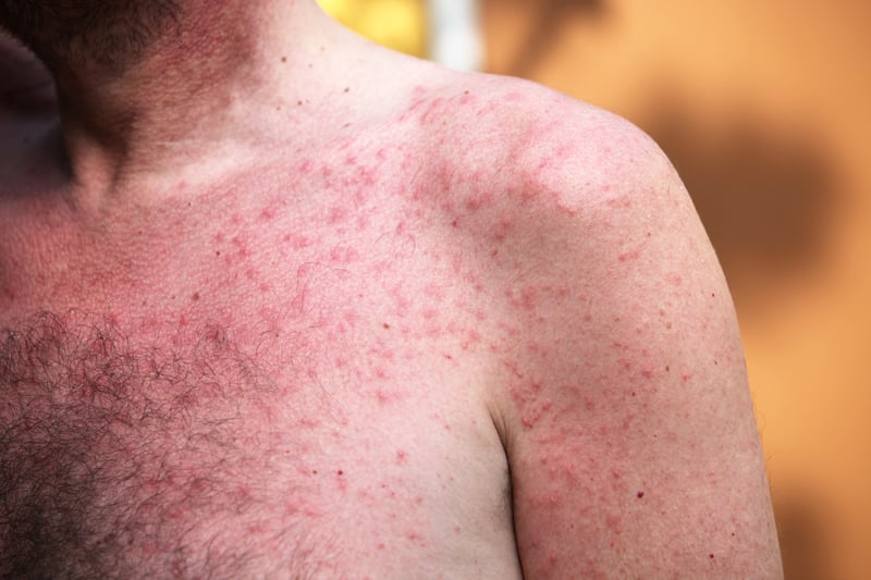  A rash usually appears one to five days after the first symptoms. The rash often begins on the face, then spreads to other parts of the body. This can include the mouth, genitals and anus