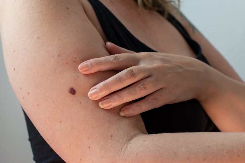 If you have a mole that changes shape or looks uneven, changes colour, starts itching, crusting or bleeding, or gets larger or more raised from the skin, it could be a sign you have malignant melanoma, which is a form of skin cancer. In most cases, a suspicious mole will be surgically removed and examined to check if it is cancerous.