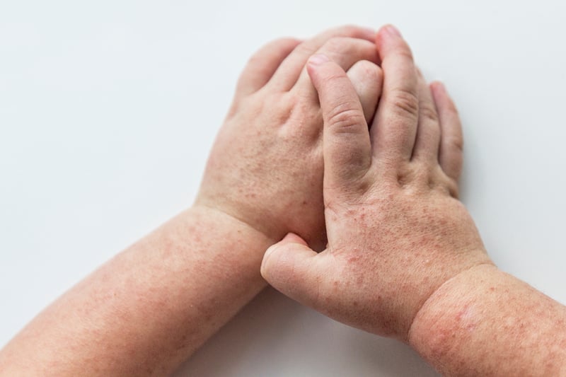A skin rash that feels rough to the touch, like sandpaper, is a common warning sign of Strep A infection and scarlet fever. The rash looks like small, raised bumps and typically starts on the chest and tummy, before spreading.