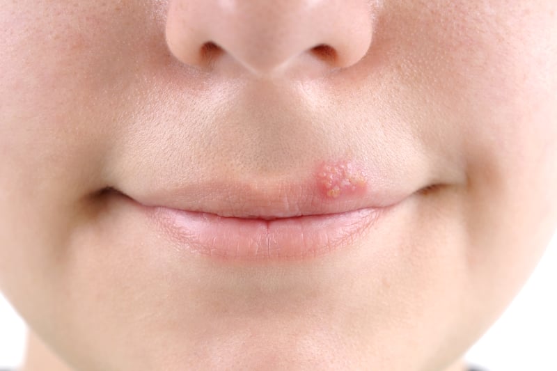 Scabs and sores can be a warning sign of Strep A infection, with some people developing impetigo. This is a highly infectious skin infection that starts with red sores or blisters which quickly burst and leave crusty, golden-brown patches.
