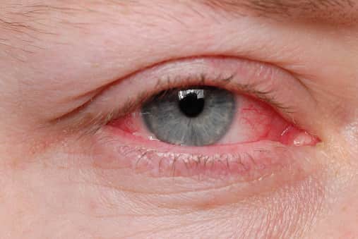 A new Covid variant, which has been found to be more infectious, is said to have an added rare symptom of conjunctivitis or pinkeye.