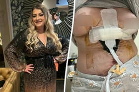 Sara Platt during happier times (L) and her right breast died and she contracted an anti-biotic resistant infection after a ’botched’ Turkish cosmetic surgery (R). (Sara Platt / SWNS)