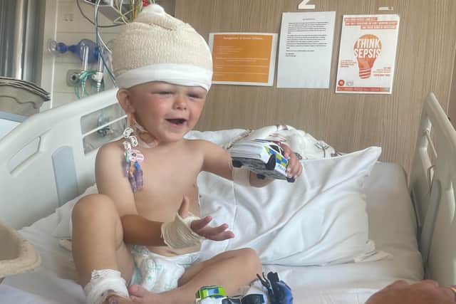 Beau, just two year’s old, had his skull broken apart by doctors and put back together like a jigsaw after an operation to stop his brain from being crushed. 
