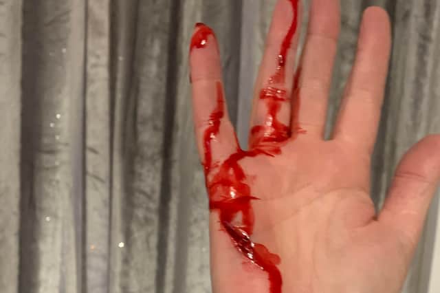 The hand wound suffered after a woman was attacked by a dog on Windmill Lane, near Firth Park, Sheffield
