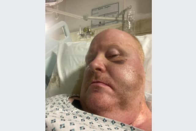 Gary Swift in hospital after being attacked in Sheffield in September 2022. He still suffers from numbness and double vision but that has not stopped him being selected to represent Team GB at the World Ability Games this December
