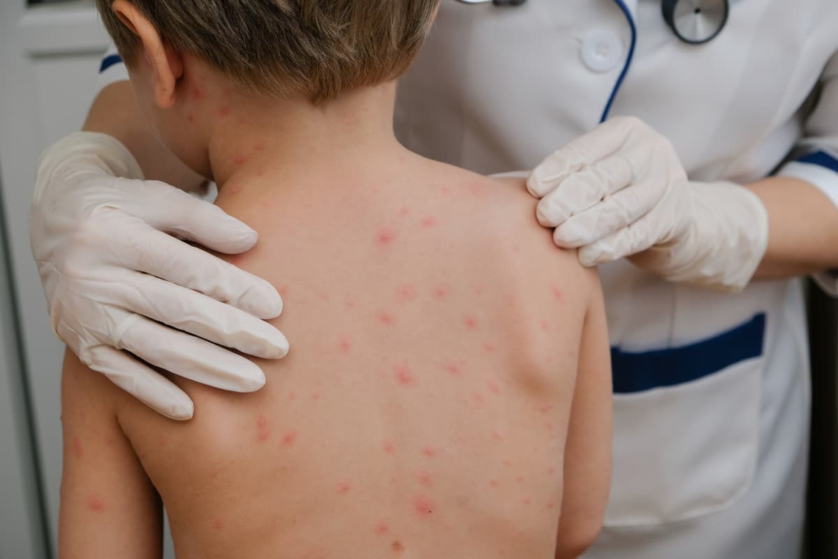 Chicken Rash Kids How to tell if your child has chickenpox or a heat rash