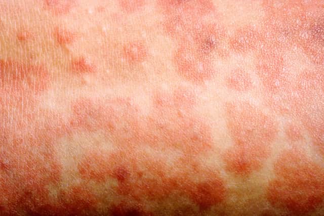 The spots of the measles rash are sometimes raised and join together to form blotchy patches.