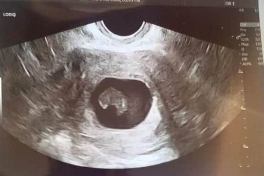 The ultrasound scan taken at 11 weeks - when Ellie was told the baby had not survived