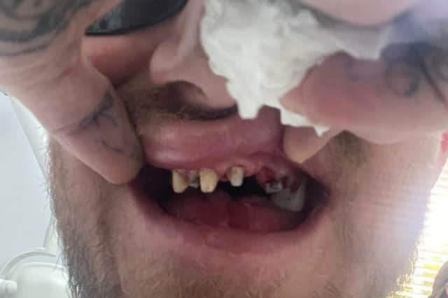 Danny's teeth after having his first set of cosmetic teeth removed in 2021 follwing an infection in his jaw. Picture: Danny Bennett / SWNS