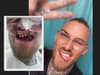 Reality TV star Danny Bennett reveals how his teeth fell out, before Sheffield dentist saved his smile