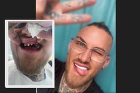 Reality TV star Danny Bennett's teeth have been saved by Sheffield dental experts. PIcture: SWNS