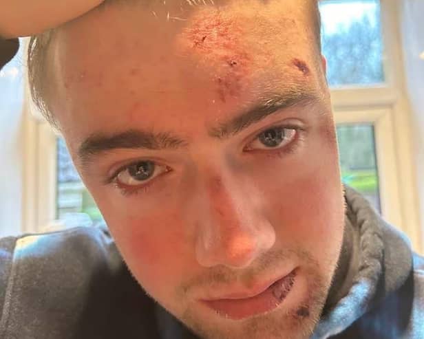 Harvey Green suffered concussion, bruises and grazes in an incident outside The Leadmill