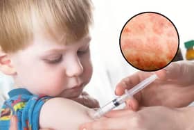 Uptake of the vaccine is at its lowest rate for more than a decade; and the UK Health Security Agency's (UKHSA) Chief Executive Professor Dame Jenny Harries has warned that an outbreak of measles in the West Midlands will spread to other towns and cities unless 'urgent action' is taken to increase vaccination uptake in areas at greatest risk
