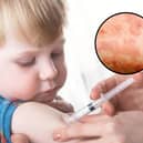 Uptake of the vaccine is at its lowest rate for more than a decade; and the UK Health Security Agency's (UKHSA) Chief Executive Professor Dame Jenny Harries has warned that an outbreak of measles in the West Midlands will spread to other towns and cities unless 'urgent action' is taken to increase vaccination uptake in areas at greatest risk