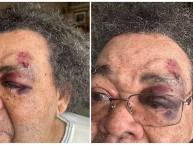 The family of a Sheffield pensioner have released photos of his injuries after he was attacked by a woman in broad daylight on Wednesday morning (March 27) in the Nether Edge area.