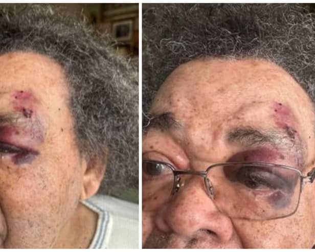 The family of a Sheffield pensioner have released photos of his injuries after he was attacked by a woman in broad daylight on Wednesday morning (March 27) in the Nether Edge area.