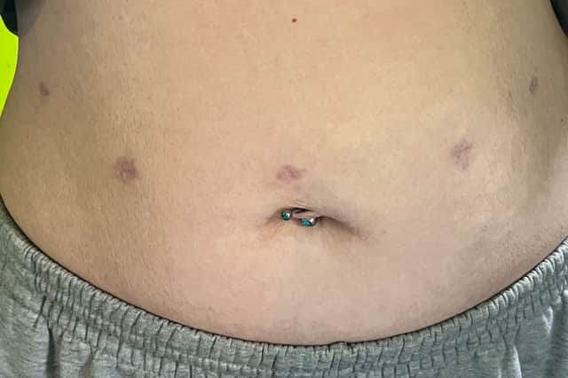 Minimal scarring from the surgery, in which Katie's cervix and womb were removed.