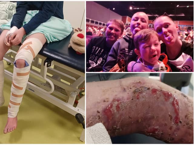 Michael Steyer, 15, suffered horrific burns and has been left unable to walk after being involved in a chip pan fire. 
