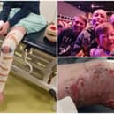 Michael Steyer, 15, suffered horrific burns and has been left unable to walk after being involved in a chip pan fire. 