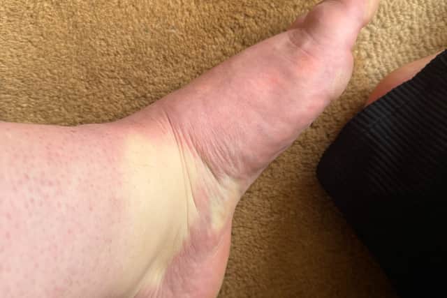 Emily Newcombe's eight-hour standing 'phone ritual' caused her foot to swell up and become extremely sore.