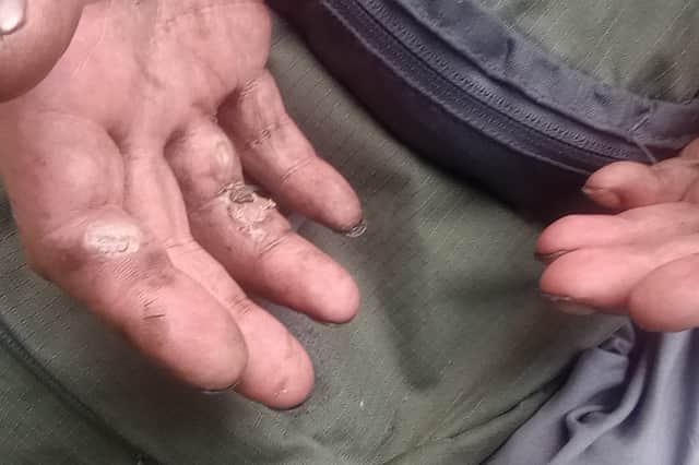 Kenny Kennedy burned his hands trying to recover items from his burning tent in Doncaster. Photo: Martin Herron