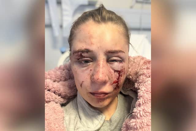Emily was rushed to hospital to be treated for injuries to her badly beaten face, arm and legs