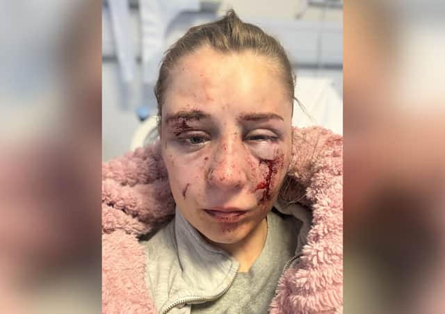 Emily was rushed to hospital to be treated for injuries to her badly beaten face, arm and legs