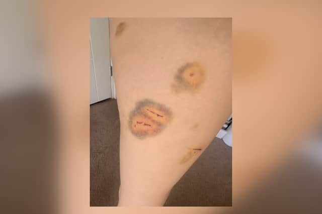Some more of Emily's injuries
