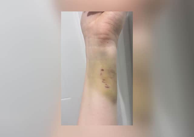 Some more of Emily's shocking injuries