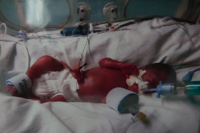 "This is Christine. She was born at 25 weeks and two days weighing one pound and 12 ounces (810g), still in hospital on oxygen but doing amazing." - Charlotte Gould-Leer