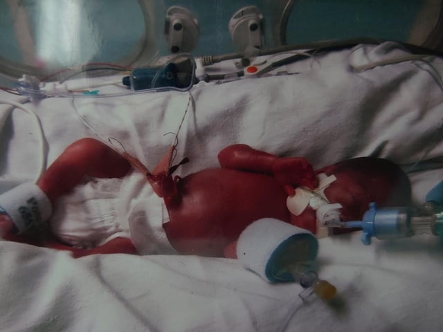"This is Christine. She was born at 25 weeks and two days weighing one pound and 12 ounces (810g), still in hospital on oxygen but doing amazing." - Charlotte Gould-Leer