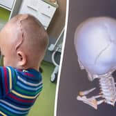 Beau Harrison was diagnosed with craniosynostosis when he was just 18 months old.