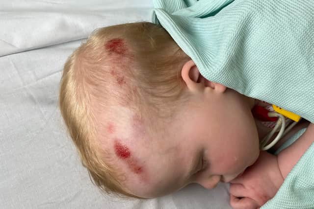 One-year-old Tommy's head injuries.