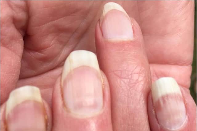 Nail markings could be a sign that somebody has had Covid (Photo: Tim Spector)