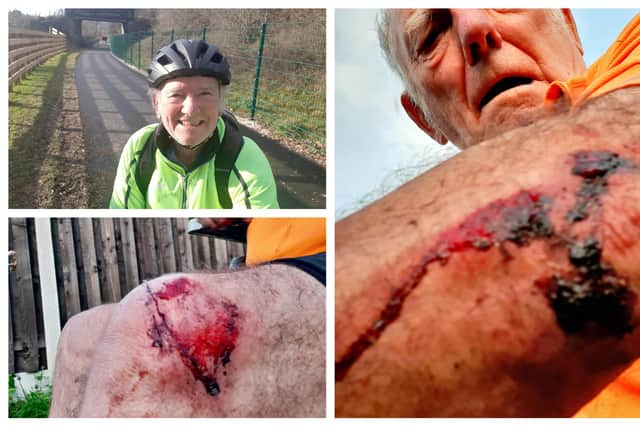 Sheffield councillor Peter Price has made a quick recovery following a nasty bike ride