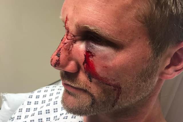 PC Dan Lumley's facial injuries