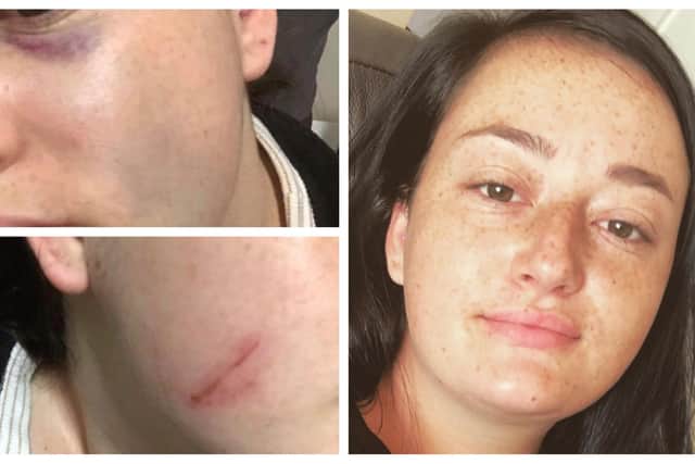 Lorna Hill's injuries after being attacked by her ex-partner, Kieron Doyle, and how she looked before