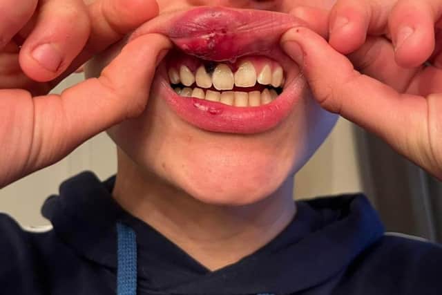 Police have re-opened an investigation after The Star looked into a reported assault on a 15 year old South Yorkshire boy. The picture shows the boy's mouth injuries