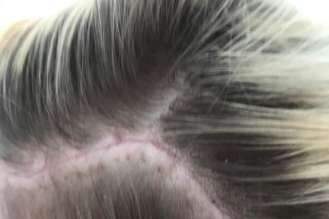 Doctors in Sheffield performed the life-saving surgery which left her with 34 staples in her head.