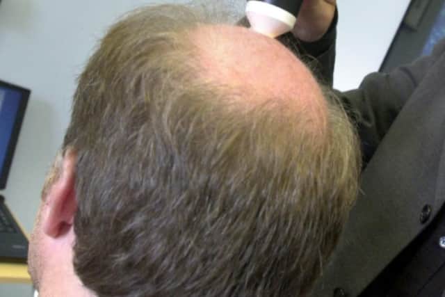 File picture shows a man with hair loss 
Picture: Darren Andrews, JPI Media