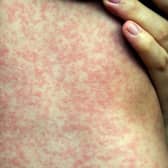 A measles outbreak in Sheffield was tackled by encouraging more children to get the MMR vaccine. Picture: NHS Inform