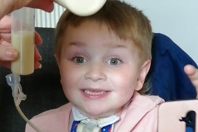 Jordan Reid, aged six, is fed through a gastrostomy placed into his stomach
