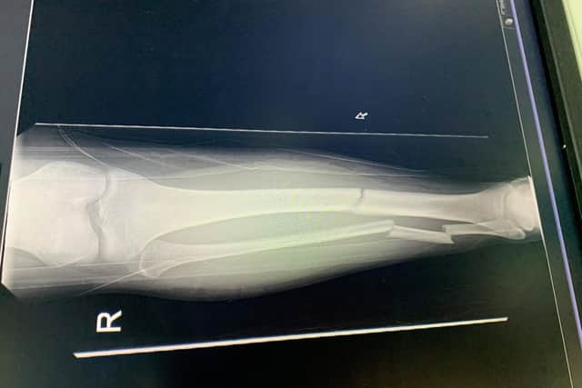 This X-ray shows how badly Connor Hedge's leg was broken when he tried to stop a thief stealing his car in Sheffield