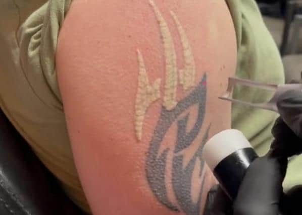 A tattoo being removed in one of the viral TikTok videos shared by Sheffield company ClearLase Tattoo Removal