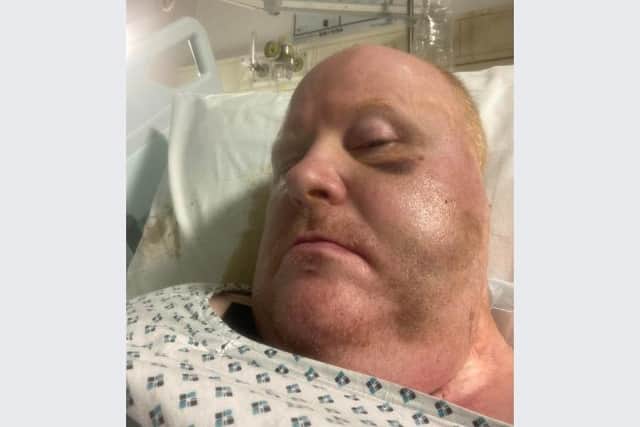 Former pool world champion Gary Swift needed surgery after he was attacked in his wheelchair on his way home from a Sheffield pub. He is pictured in hospital