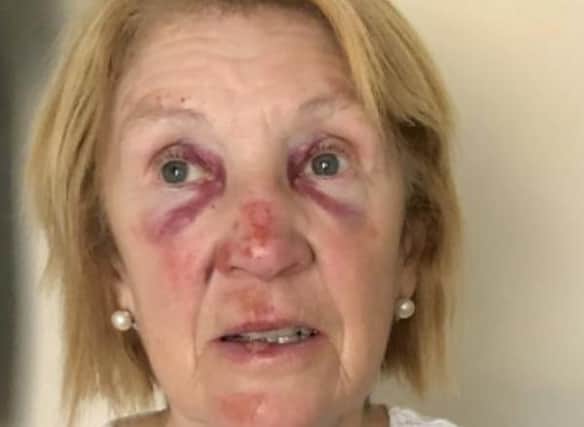 Gail was injured after falling over a sign on a pavement