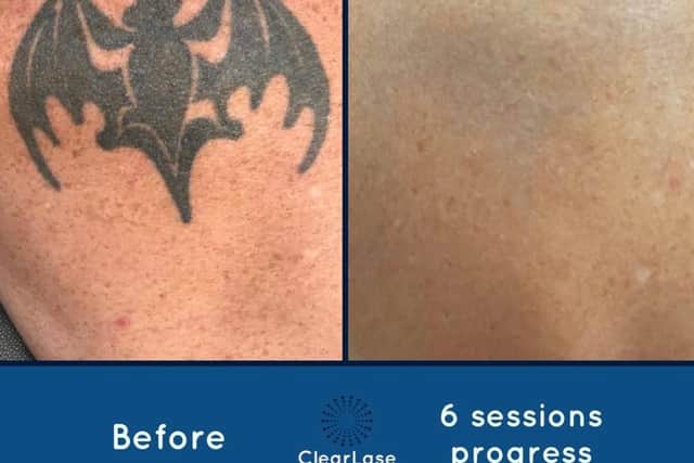 Before and after photos of a tattoo which was zapped by ClearLase Tattoo Removal in Sheffield (pic: ClearLase Tattoo Removal)