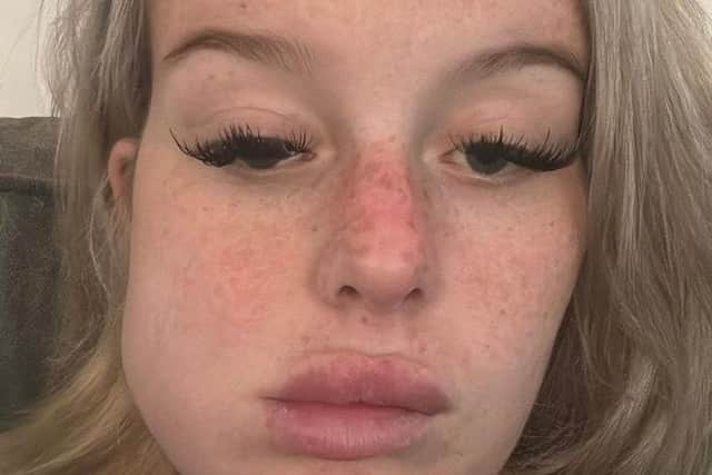 Mollie Dougherty's swollen jaw as a result of the stage 2 cancer